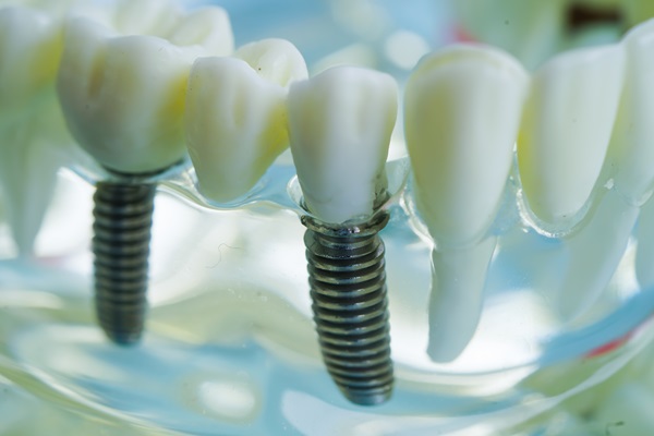 Discover The Lifelong Benefits Of A Dental Implant For Your Oral Health