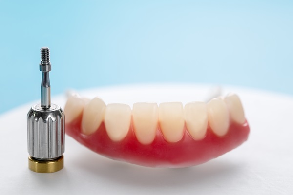 How Common Are Implant Supported Dentures?